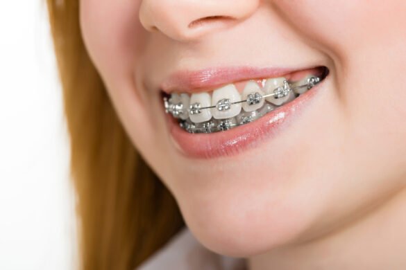 dental implants and braces